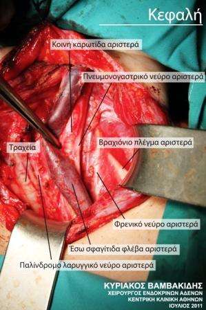 Cervical lymph node dissection in cancer of the thyroid gland.