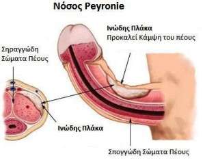 Peyronie1