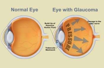 Glaucoma-Eye-1024x674