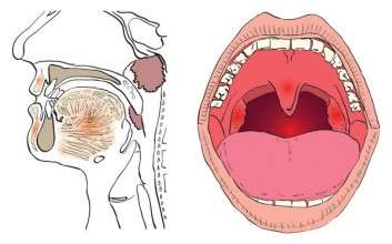 Οξεία Φαρυγγοαμυγδαλίτιδα