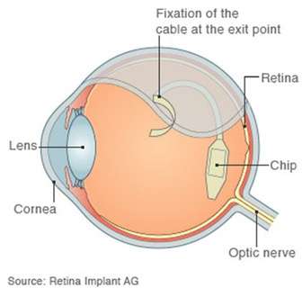 Μικροτσίπ αποκαθιστά την όραση ατόμων με ολική τύφλωση
