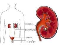 λιθίαση των νεφρών, λιθίαση των ουρητήρων, λιθίαση της ουροδόχου κύστης και τέλος λιθίαση της ουρήθρας.