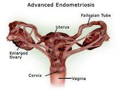 Ενδομητρίωση ΕΝΔΟΜΗΤΡΙΩΣΗ:ΠΡΟΚΕΙΤΑΙ ΓΙΑ ΑΣΘΕΝΕΙΑ;