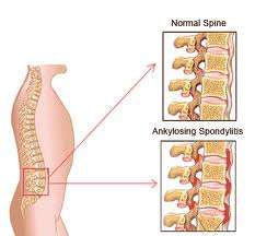 Αγκυλωτική Σπονδυλιτιδα