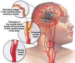 Τα Αγγειακά Εγκεφαλικά Επεισόδια (ΑΕΕ) και οι Τραυματικές κακώσεις του Εγκεφάλου