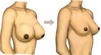 Νεανική μεγαλομαστία (Virginal Breast Hypertrophy)