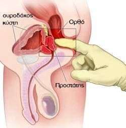 prostatis-daktyliki