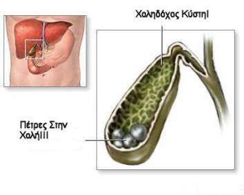 Χολολιθίαση μία πολύ συχνή πάθηση