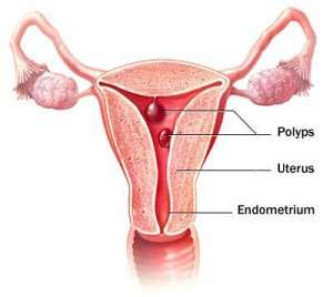 polypodes-endomitriou