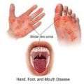 Νόσος χεριών-ποδιών-στόματος (συχνά αναφερόμενη και ως “νόσος Coxsackie”)