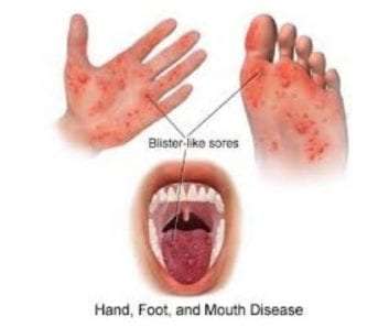 Νόσος χεριών-ποδιών-στόματος (συχνά αναφερόμενη και ως “νόσος Coxsackie”)
