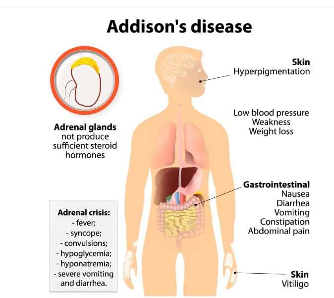Νόσος Αddison