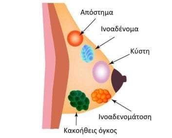 Κατανόηση των προβλημάτων του μαστού.