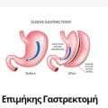 Επιμήκης Γαστρεκτομή (Sleeve Gastrectomy)