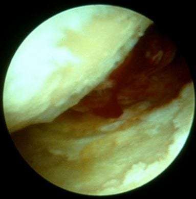 Αρθροσκοπική εικόνα ισχίου με οστεοαρθρίτιδα μετά το debridement