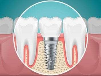 Τι πρέπει να γνωρίζουμε για τα οδοντικά εμφυτεύματα;