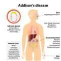 Οδηγίες για τη λήψη υδροκορτιζόνης για την πρόληψη κρίσης Addison