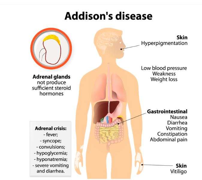 Οδηγίες για τη λήψη υδροκορτιζόνης για την πρόληψη κρίσης Addison