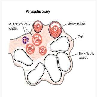 Πολυκυστικές Ωοθήκες