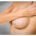 Αυξητική στήθους: Τι πρέπει να γνωρίζετε για την δημοφιλή αισθητική επέμβαση και το κόστος της