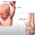 Εξάρθρημα αγκώνα σε μωρά – επώδυνος πρηνισμός (Nursemaid Elbow)