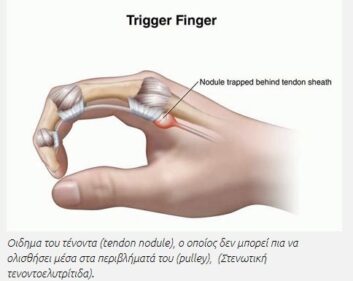 Ο εκτινασσόμενος δάκτυλος ή στενωτική τενοντοελυτρίτιδα αποτελεί μια συχνή κλινική οντότητα η οποία χαρακτηρίζεται από επώδυνο ‘κλείδωμα’ του δακτύλου.