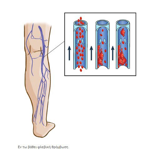 Eν τω βάθει φλεβική θρόμβωση