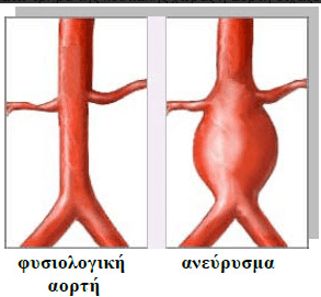 Τι είναι το ανεύρυσμα της κοιλιακής αορτής: