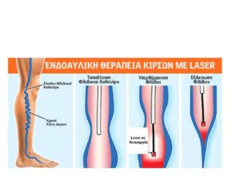 Ενδοαυλική Θεραπεία Κιρσών με Laser